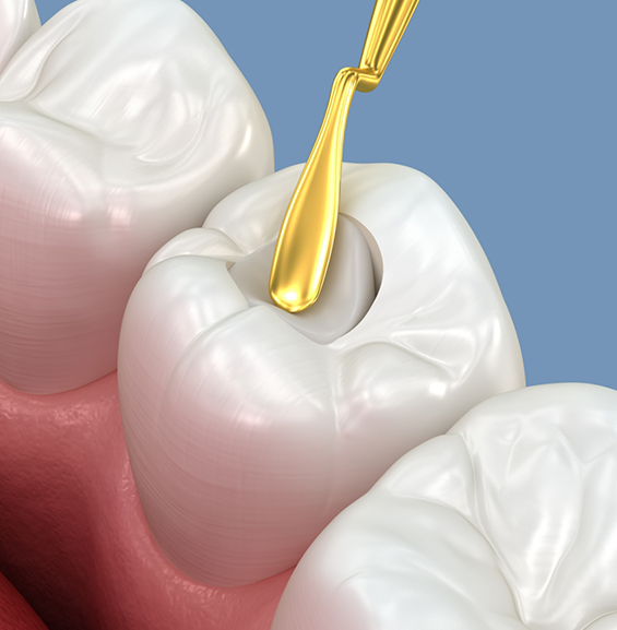 Illustration of a white filling being placed inside of a tooth
