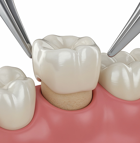 Illustration of a dental crown being placed over a tooth