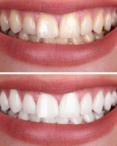 Closeup of patient's smile before and after teeth whitening